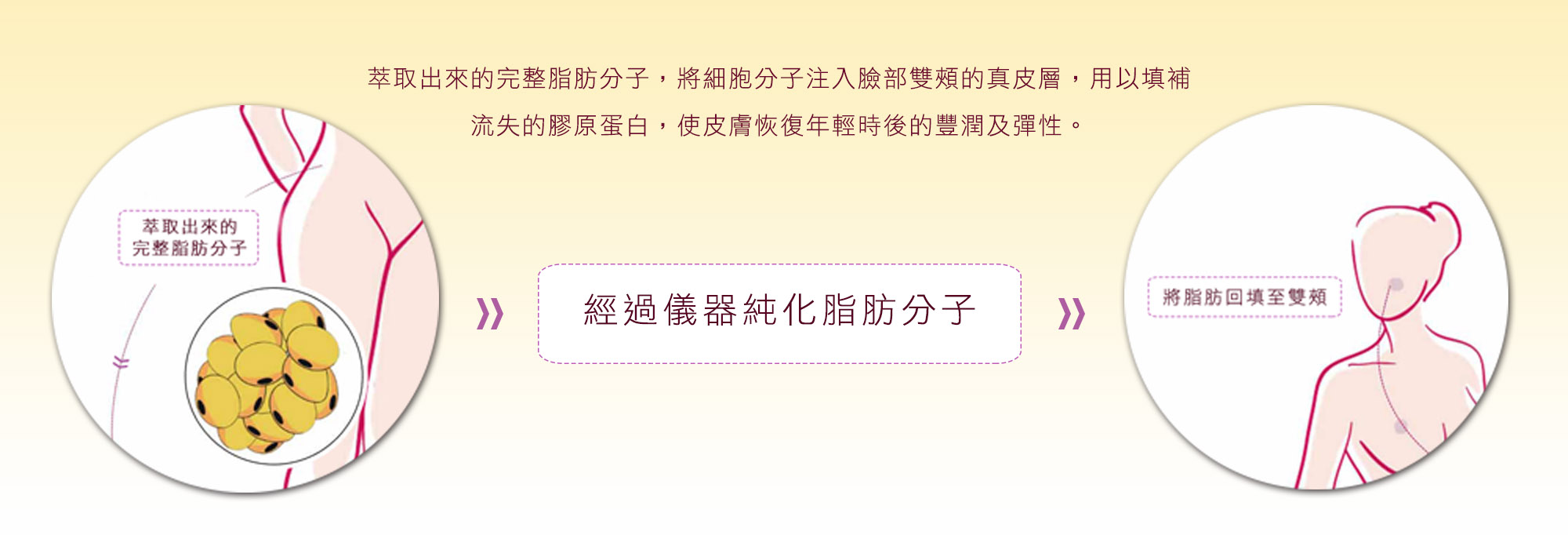 嘉義自體脂肪豐頰補臉權威醫師推薦002