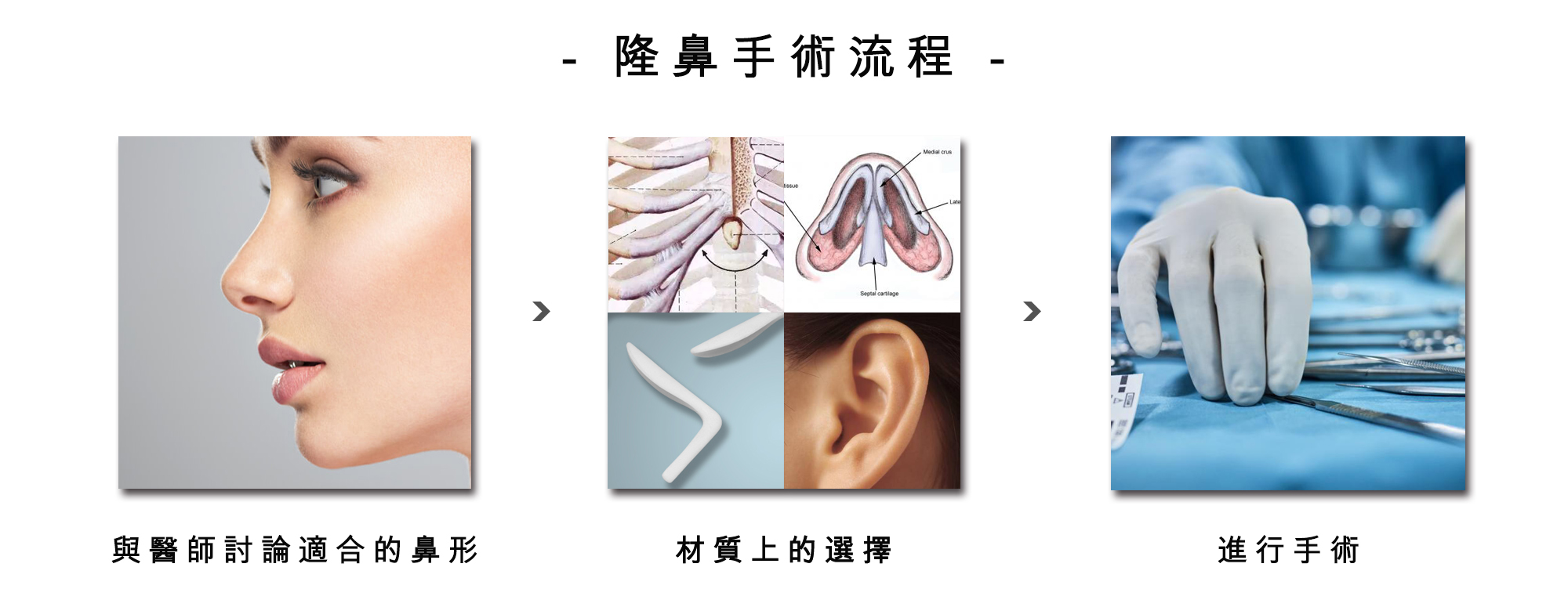 隆鼻手術流程   隆鼻手術其實可以很複雜。從鼻子的解剖結構來看，要到達一個符合自己期待的鼻型，不管是從山根、鼻頭、鼻柱、鼻翼等等，都有極大的可能需要進行調整。