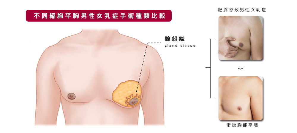 何文藻縮胸平胸男性女乳症